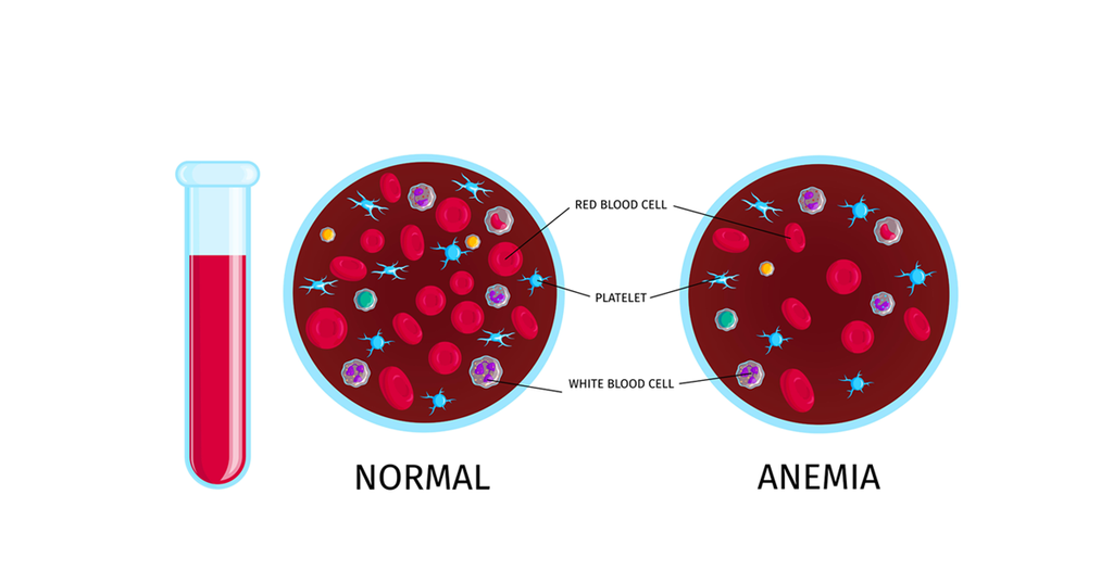 HOW AUTOIMMUNE PROTOCOL DIET WILL HELP FIGHT ANEMIA